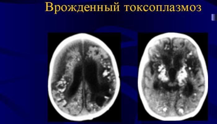 Токсоплазма — паразит в головном мозге